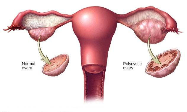 Best Dr for PCOS Treatment in Mumbai