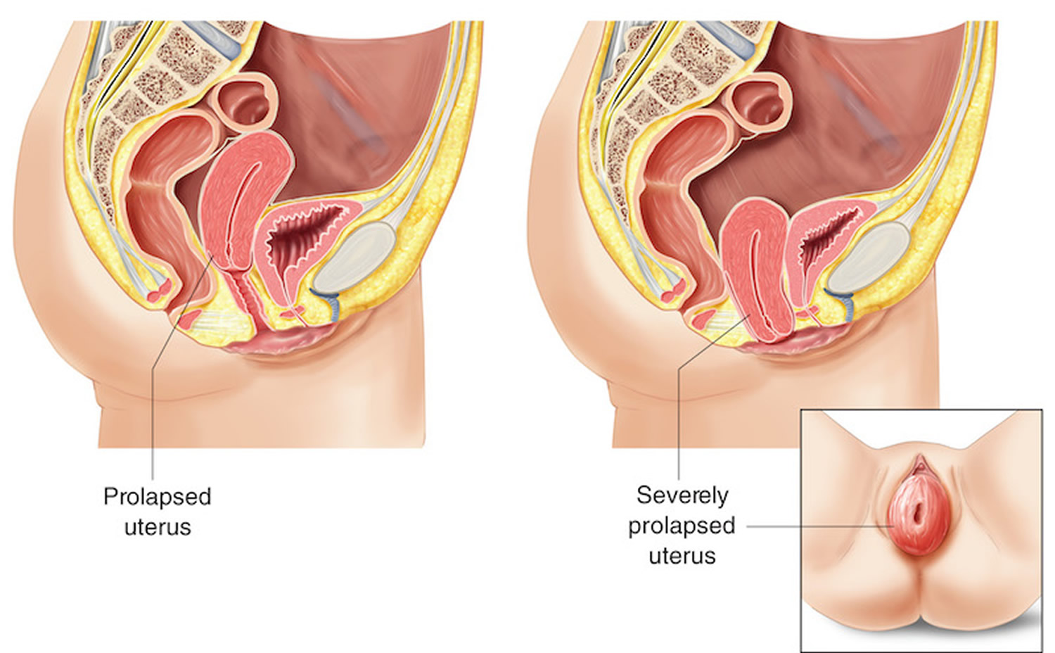 Uterine prolapse treatment by Robotic Surgery